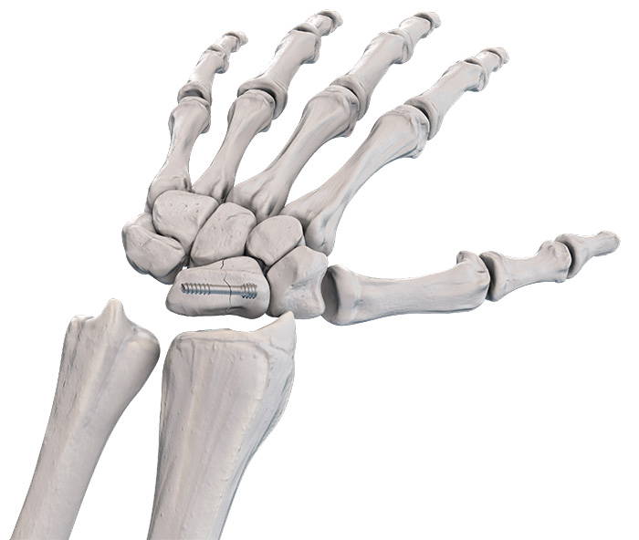 Hand_CS Small