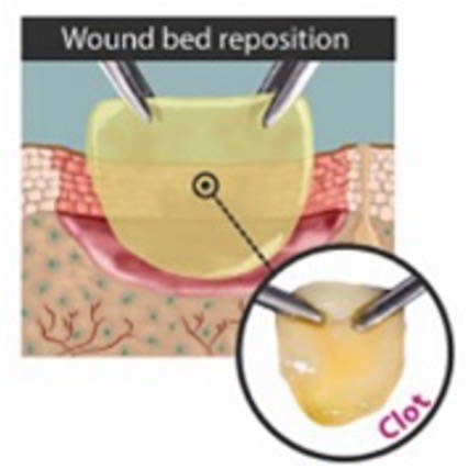 Endoret Clot